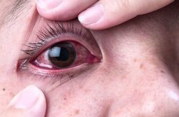Bệnh đau mắt đỏ là gì? Phòng chống bệnh đau mắt đỏ như thế nào?