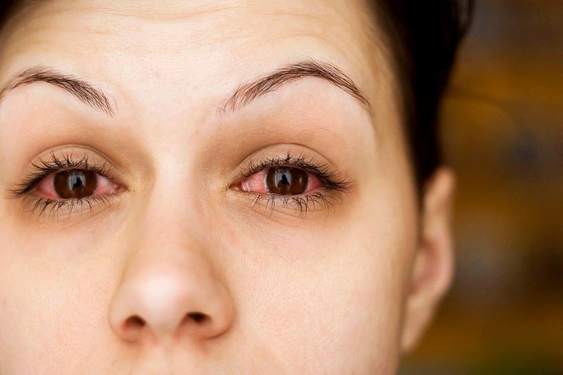 bệnh đau mắt đỏ là gì
